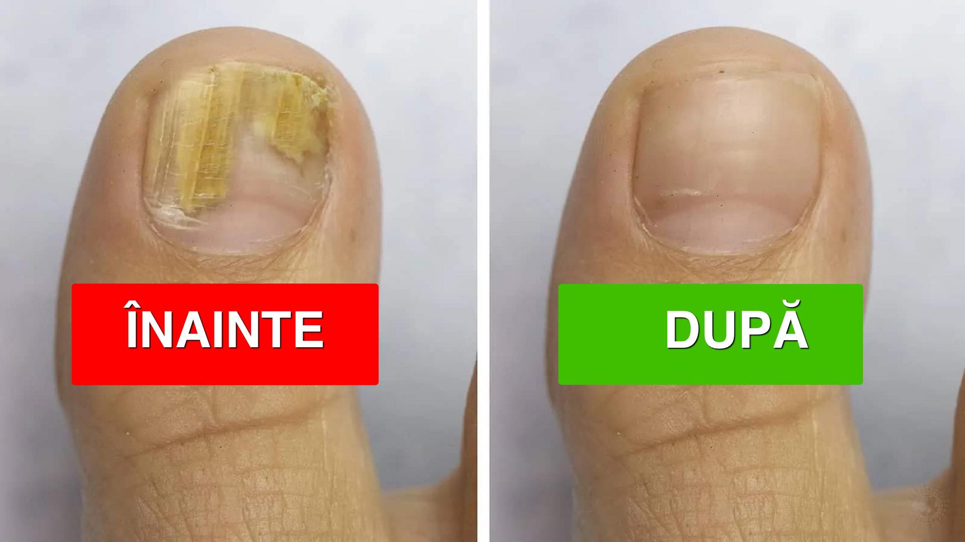 cum să eliminați complet ciuperca de pe unghie