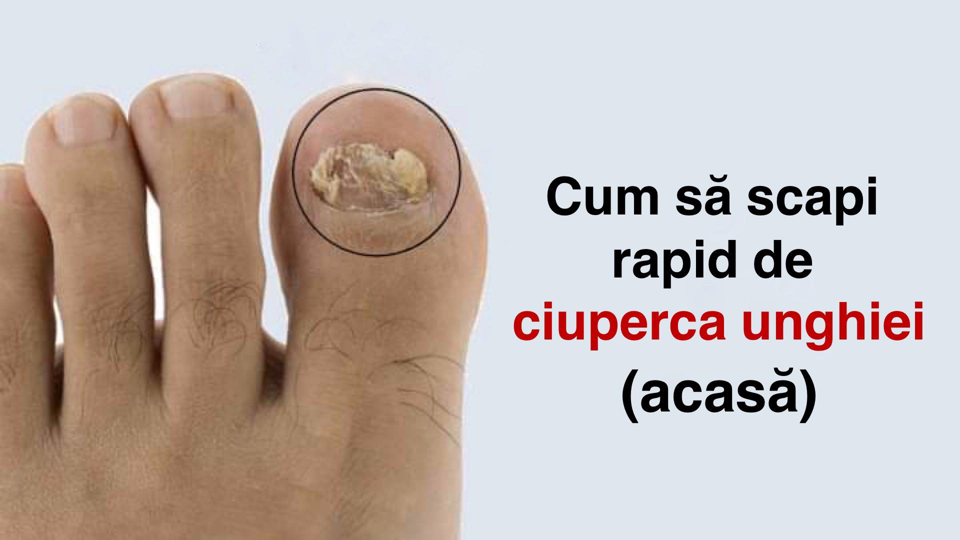 ciuperca unghiilor de la picioare cura lungă prevenirea ciupercilor unghiilor remedii populare